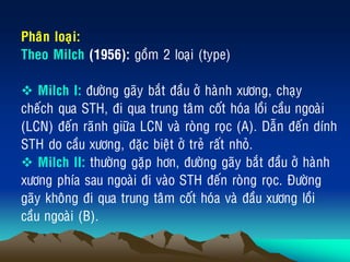 Phaân loaïi:
Theo Milch (1956): goàm 2 loaïi (type)
 Milch I: ñöôøng gaõy baét ñaàu ôû haønh xöông, chaïy
cheách qua STH, ñi qua trung taâm coát hoùa loài caàu ngoaøi
(LCN) ñeán raõnh giöõa LCN vaø roøng roïc (A). Daãn ñeán dính
STH do caàu xöông, ñaëc bieät ôû treû raát nhoû.
 Milch II: thöôøng gaëp hôn, ñöôøng gaõy baét ñaàu ôû haønh
xöông phía sau ngoaøi ñi vaøo STH ñeán roøng roïc. Ñöôøng
gaõy khoâng ñi qua trung taâm coát hoùa vaø ñaàu xöông loài
caàu ngoaøi (B).
 