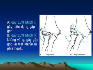 A: gaõy LCN Milch I,
gaây bieán daïng gaäp
goùc.
B: gaõy LCN Milch II,
khoâng vöõng, gaây gaäp
goùc vaø traät khuyûu ra
phía ngoaøi.
 