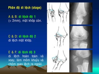 A & B: di leäch ñoä 1
(< 2mm), maët khôùp coøn.
C & D: di leäch ñoä 2
di leäch maët khôùp.
E & F: di leäch ñoä 3
di leäch hoaøn toaøn vaø
xoay, laøm moûm khuyûu vaø
choûm quay leäch ra ngoaøi.
Phaân ñoä di leäch (stage)
 