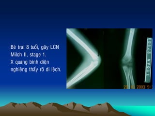 Beù trai 8 tuoåi, gaõy LCN
Milch II, stage 1.
X quang bình dieän
nghieâng thaáy roõ di leäch.
 