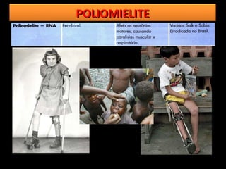 POLIOMIELITE
 