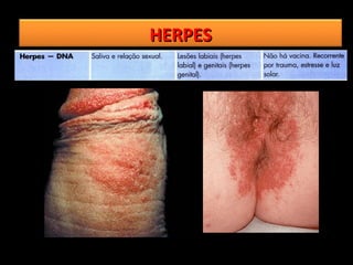 HERPES
 