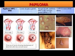 PAPILOMA
 