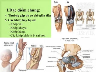 I.Đặc điểm chung:
4. Thường gặp do cơ chế gián tiếp.
5. Các khớp hay bị sai:
- Khớp vai.
- Khớp khuỷu.
- Khớp háng.
- Các khớp khác ít bị sai hơn

 