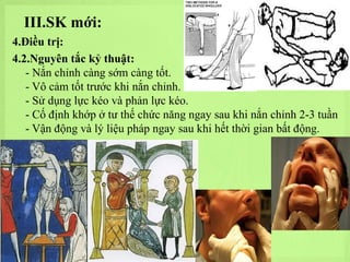 III.SK mới:
4.Điều trị:
4.2.Nguyên tắc kỷ thuật:
- Nắn chỉnh càng sớm càng tốt.
- Vô cảm tốt trước khi nắn chỉnh.
- Sử dụng lực kéo và phản lực kéo.
- Cố định khớp ở tư thế chức năng ngay sau khi nắn chỉnh 2-3 tuần
- Vận động và lý liệu pháp ngay sau khi hết thời gian bất động.

 