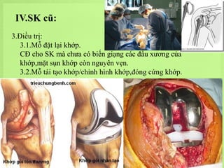 IV.SK cũ:
3.Điều trị:
3.1.Mỗ đặt lại khớp.
CĐ cho SK mà chưa có biến giạng các đầu xương của
khớp,mặt sụn khớp còn nguyên vẹn.
3.2.Mỗ tái tạo khớp/chỉnh hình khớp,đóng cứng khớp.

 