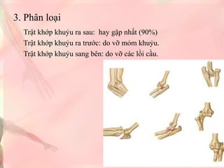 3. Phân loại
Trật khớp khuỷu ra sau: hay gặp nhất (90%)
Trật khớp khuỷu ra trước: do vỡ mỏm khuỷu.
Trật khớp khuỷu sang bên: do vỡ các lồi cầu.

 