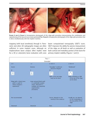 mapping (with local anesthesia) through it. Pano-
ramic and other 2D radiographic images are often
sufficient in some implant cases, although an
implant-driven bone analysis often implies need
for a 3D or volumetric bone evaluation with cone
beam computerized tomography (CBCT) scans.
CBCT improves the ability for precise measurement
of the ridge on all levels as well as evaluation of
both cortical and medullary portion of the bone for
primary implant stability (Figures 1 and 2).
TABLE 1
Extended
2–4 ,2 6–10/2–4 2–4/6–10
Severe Extreme ‘‘Hourglass’’ (undercut)
(buccal or lingual)
‘‘Bottleneck’’
IV V VI VII
GBRÀ at the mid ridge
level can be done
Ridge reshaping or GBR
at the top of the ridge
can be done
Ridge-split or block bone
graft is a graft of
choice (surgeon’s
experience).
Large extraoral block graft
is a preferable surgical
choice. Alternative is
multiple and sequential
augmentation
procedures.
Not recommended No Yes/no, depends on the
severity of the undercut
Usually yes, can depend
on the morphology of
the top portion of the
ridge
Advanced Advanced Basic Basic
FIGURES 3 AND 4. FIGURE 3. Intraoperative photograph of the ridge-split procedure demonstrating the mobilization and
repositioning of the buccal muco-osteo-periosteal flap. FIGURE 4. Intraoperative photograph of the ridge-split procedure that
is done simultaneously with the implant insertion.
Journal of Oral Implantology 367
Tolstunov
 