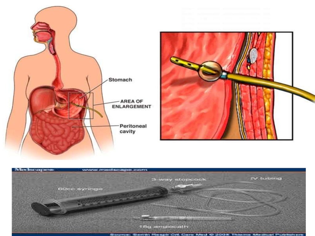 Percutaneous Endoscopic Gastrostomy