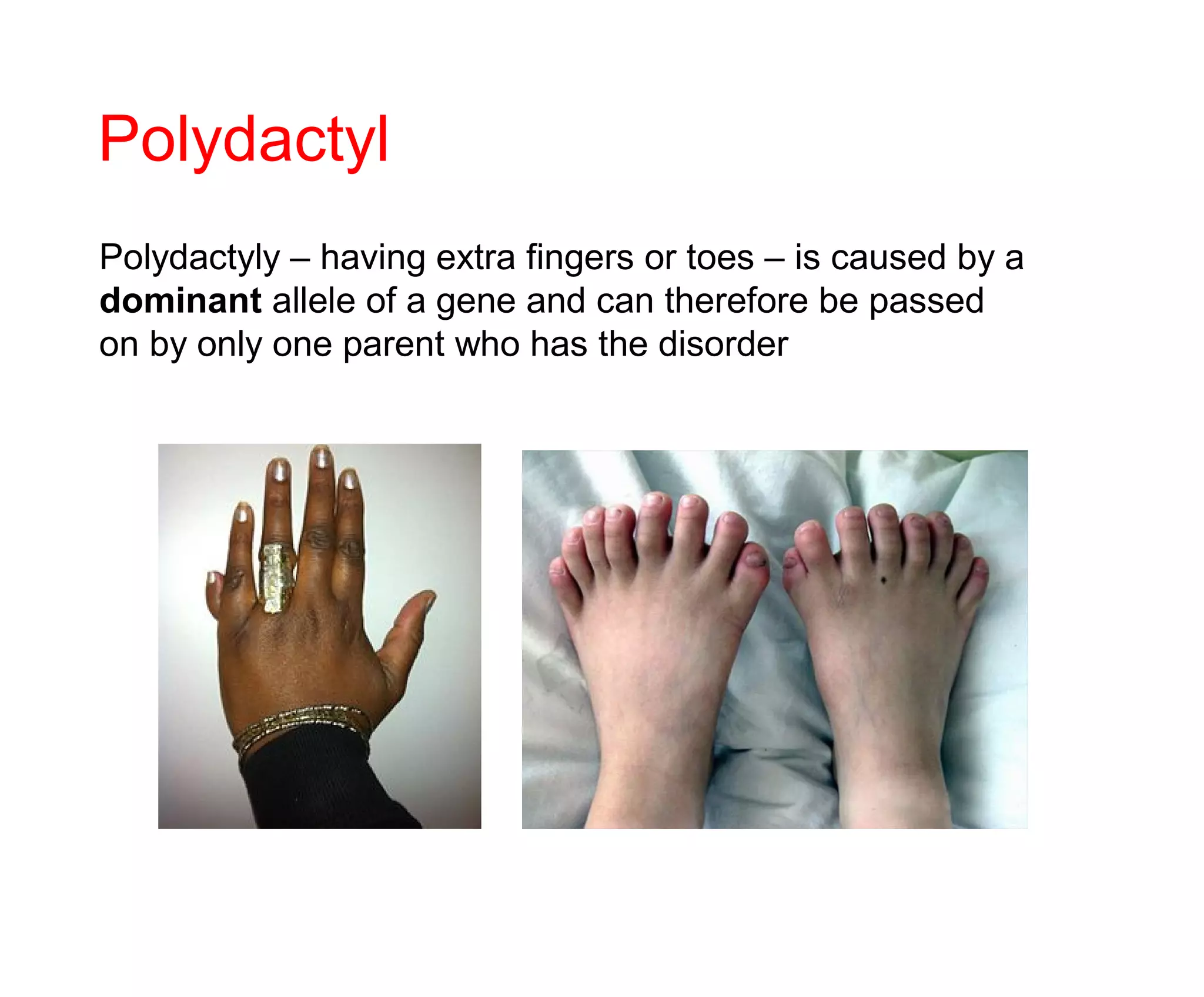 Polydactyl
Polydactyly – having extra fingers or toes – is caused by a
dominant allele of a gene and can therefore be passed
on by only one parent who has the disorder
 