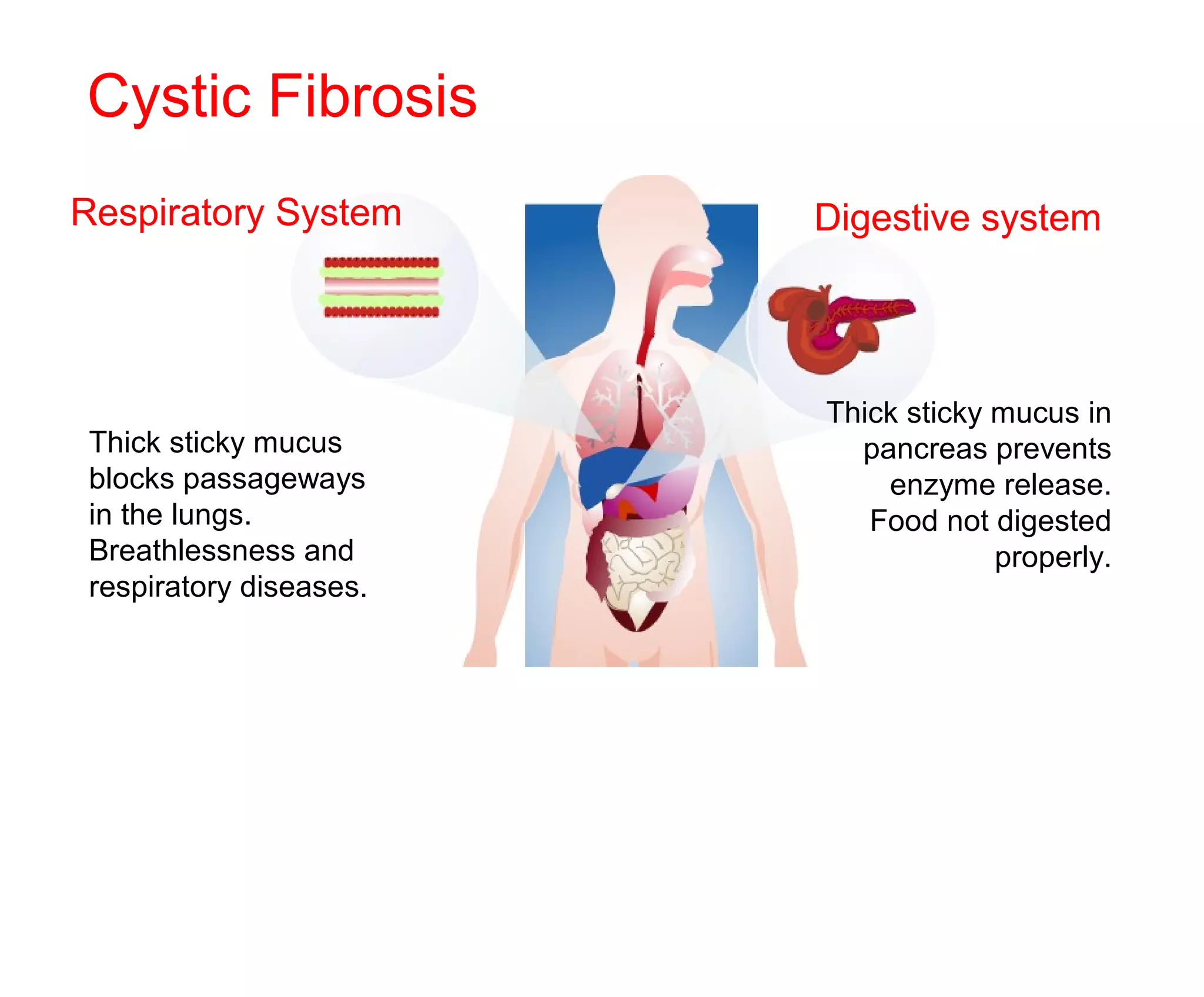 Cystic Fibrosis
Digestive system
Thick sticky mucus in
pancreas prevents
enzyme release.
Food not digested
properly.
Respiratory System
Thick sticky mucus
blocks passageways
in the lungs.
Breathlessness and
respiratory diseases.
 