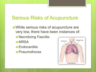 Serious Risks of Acupuncture
While serious risks of acupuncture are
very low, there have been instances of:
 Necrotizing Fasciitis
 MRSA
 Endocarditis
 Pneumothorax
 