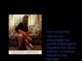 Cystic Fibrosis
• The treatment
involves chest
physiotherapy.
• They are very prone
to chest infections
and malnutrition.
• The mucus
encourages the
growth of pathogenic
microbes that cause
infection and cause
long term lung
damage.
 