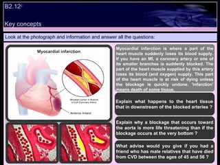 Key concepts B2.12 c   Look at the photograph and information and answer all the questions: Myocardial infarction is where a part of the heart muscle suddenly loses its blood supply. If you have an MI, a coronary artery or one of its smaller branches is suddenly blocked. The part of the heart muscle supplied by this artery loses its blood (and oxygen) supply. This part of the heart muscle is at risk of dying unless the blockage is quickly undone. 'infarction' means death of some tissue. Explain what happens to the heart tissue that in downstream of the blocked arteries ? Explain why a blockage that occurs toward the aorta is more life threatening than if the blockage occurs at the very bottom ? What advise would you give if you had a friend who has male relatives that have died from CVD between the ages of 45 and 56 ? Myocardial infarction 