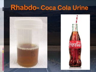 Rhabdo- Coca Cola Urine
 