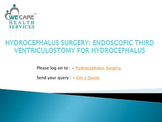 Hydrocephalus Surgery: Endoscopic Third Ventriculostomy for Hydrocephalus Please log on to : - Hydrocephalus Surgery Send your query : - Get a Quote 