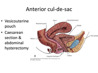 Anterior cul-de-sac
• Vesicouterine
pouch
• Caesarean
section &
abdominal
hysterectomy
 
