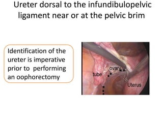 Ureter dorsal to the infundibulopelvic
ligament near or at the pelvic brim
Identification of the
ureter is imperative
prior to performing
an oophorectomy
 