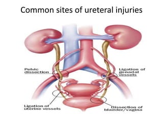 Common sites of ureteral injuries
 