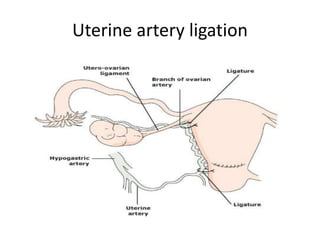 Uterine artery ligation
 