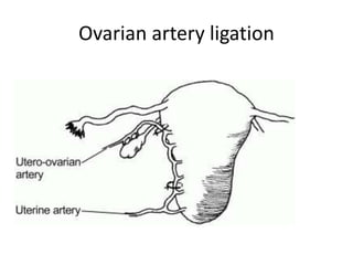 Ovarian artery ligation
 