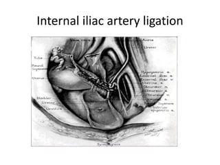 Internal iliac artery ligation
 