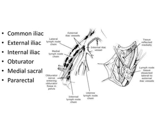 • Common iliac
• External iliac
• Internal iliac
• Obturator
• Medial sacral
• Pararectal
 