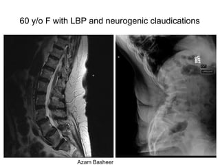 60 y/o F with LBP and neurogenic claudications
Azam Basheer
 