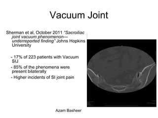 Vacuum Joint
Sherman et al, October 2011 “Sacroiliac
joint vacuum phenomenon—
underreported finding” Johns Hopkins
University
- 17% of 223 patients with Vacuum
SIJ
- 85% of the phenomena were
present bilaterally
- Higher incidents of SI joint pain
Azam Basheer
 