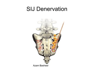 SIJ Denervation
Azam Basheer
 