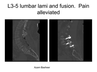 L3-5 lumbar lami and fusion. Pain
alleviated
Azam Basheer
 