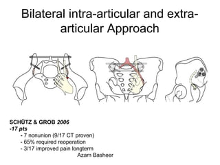 Bilateral intra-articular and extra-
articular Approach
SCHÜTZ & GROB 2006
-17 pts
- 7 nonunion (9/17 CT proven)
- 65% required reoperation
- 3/17 improved pain longterm
Azam Basheer
 