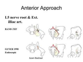 Anterior Approach
L5 nerve root & Ext.
illiac art.
RAND 1985
GUNER 1998
Endoscopic
Azam Basheer
 