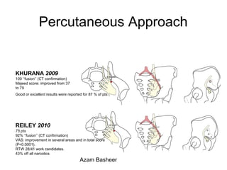 Percutaneous Approach
KHURANA 2009
100 ‘‘fusion’’ (CT confirmation)
Majeed score: improved from 37
to 79
Good or excellent results were reported for 87 % of pts
REILEY 2010
75 pts
92% ‘‘fusion’’ (CT confirmation)
VAS: improvement in several areas and in total score
(P<0.0001).
RTW 28/41 work candidates.
43% off all narcotics
Azam Basheer
 