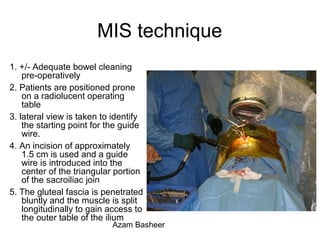 MIS technique
1. +/- Adequate bowel cleaning
pre-operatively
2. Patients are positioned prone
on a radiolucent operating
table
3. lateral view is taken to identify
the starting point for the guide
wire.
4. An incision of approximately
1.5 cm is used and a guide
wire is introduced into the
center of the triangular portion
of the sacroiliac join
5. The gluteal fascia is penetrated
bluntly and the muscle is split
longitudinally to gain access to
the outer table of the ilium
Azam Basheer
 