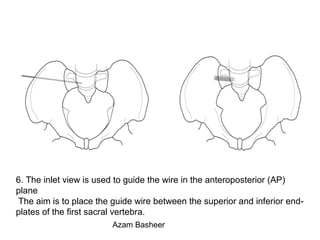 6. The inlet view is used to guide the wire in the anteroposterior (AP)
plane
The aim is to place the guide wire between the superior and inferior end-
plates of the first sacral vertebra.
Azam Basheer
 