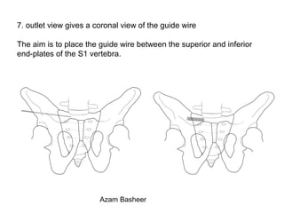 7. outlet view gives a coronal view of the guide wire
The aim is to place the guide wire between the superior and inferior
end-plates of the S1 vertebra.
Azam Basheer
 