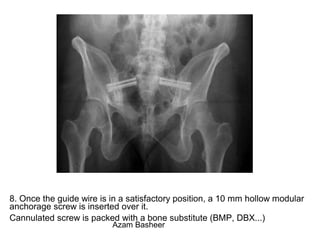 8. Once the guide wire is in a satisfactory position, a 10 mm hollow modular
anchorage screw is inserted over it.
Cannulated screw is packed with a bone substitute (BMP, DBX...)
Azam Basheer
 