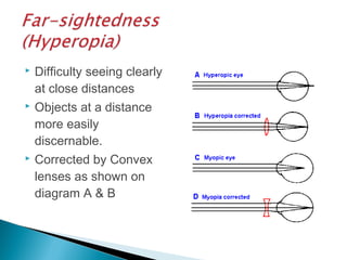  Difficulty seeing clearly
at close distances
 Objects at a distance
more easily
discernable.
 Corrected by Convex
lenses as shown on
diagram A & B
 