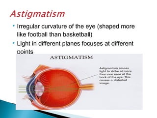  Irregular curvature of the eye (shaped more
like football than basketball)
 Light in different planes focuses at different
points
 