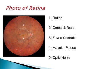 1) Retina
2) Cones & Rods
3) Fovea Centralis
4) Macular Plaque
5) Optic Nerve
 