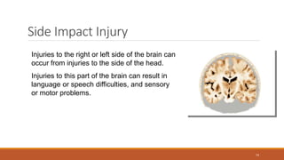 Side Impact Injury
Injuries to the right or left side of the brain can
occur from injuries to the side of the head.
Injuries to this part of the brain can result in
language or speech difficulties, and sensory
or motor problems.
74
 