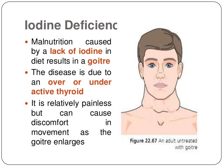 lack of iodine in the diet can cause