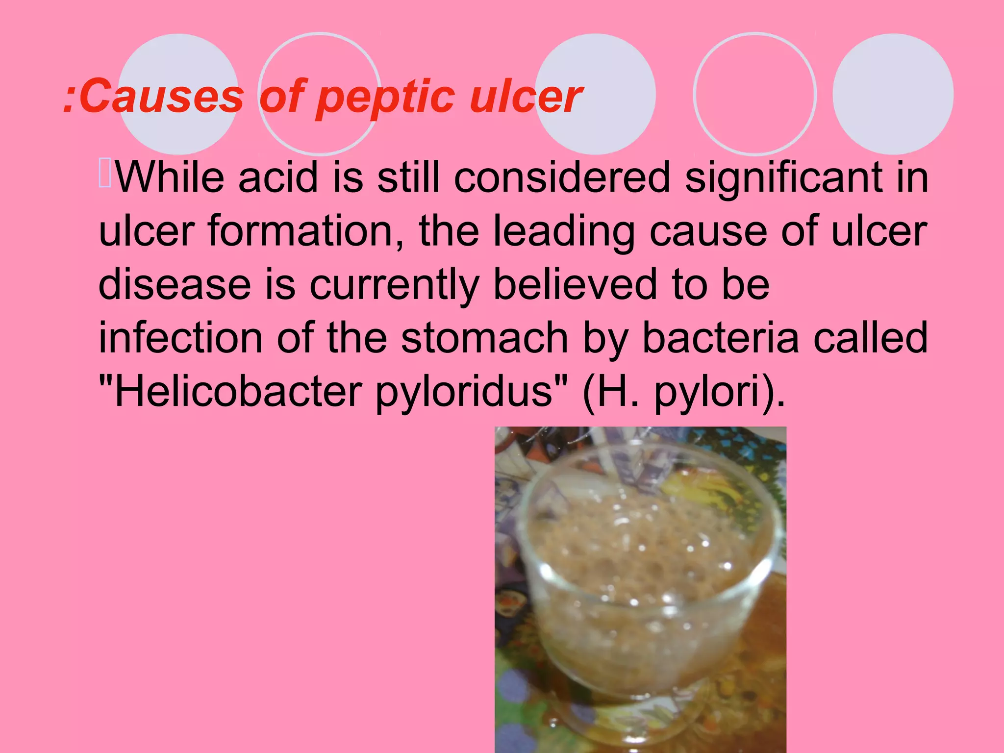 Causes of peptic ulcer:
While acid is still considered significant in
ulcer formation, the leading cause of ulcer
disease is currently believed to be
infection of the stomach by bacteria called
"Helicobacter pyloridus" (H. pylori).
 
