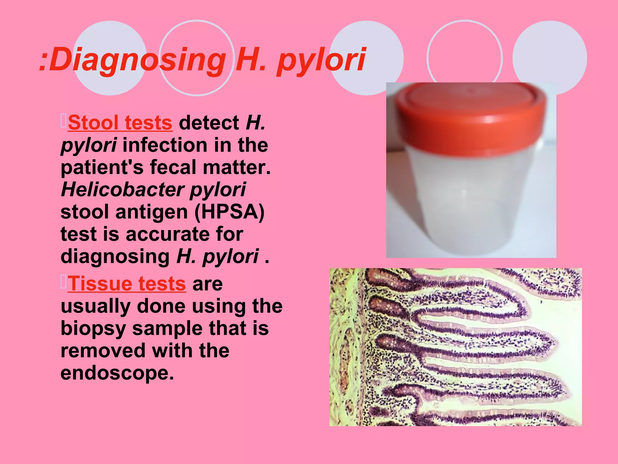 Diagnosing H. pylori:
Stool tests detect H.
pylori infection in the
patient's fecal matter.
Helicobacter pylori
stool antigen (HPSA)
test is accurate for
diagnosing H. pylori .
Tissue tests are
usually done using the
biopsy sample that is
removed with the
endoscope.
 