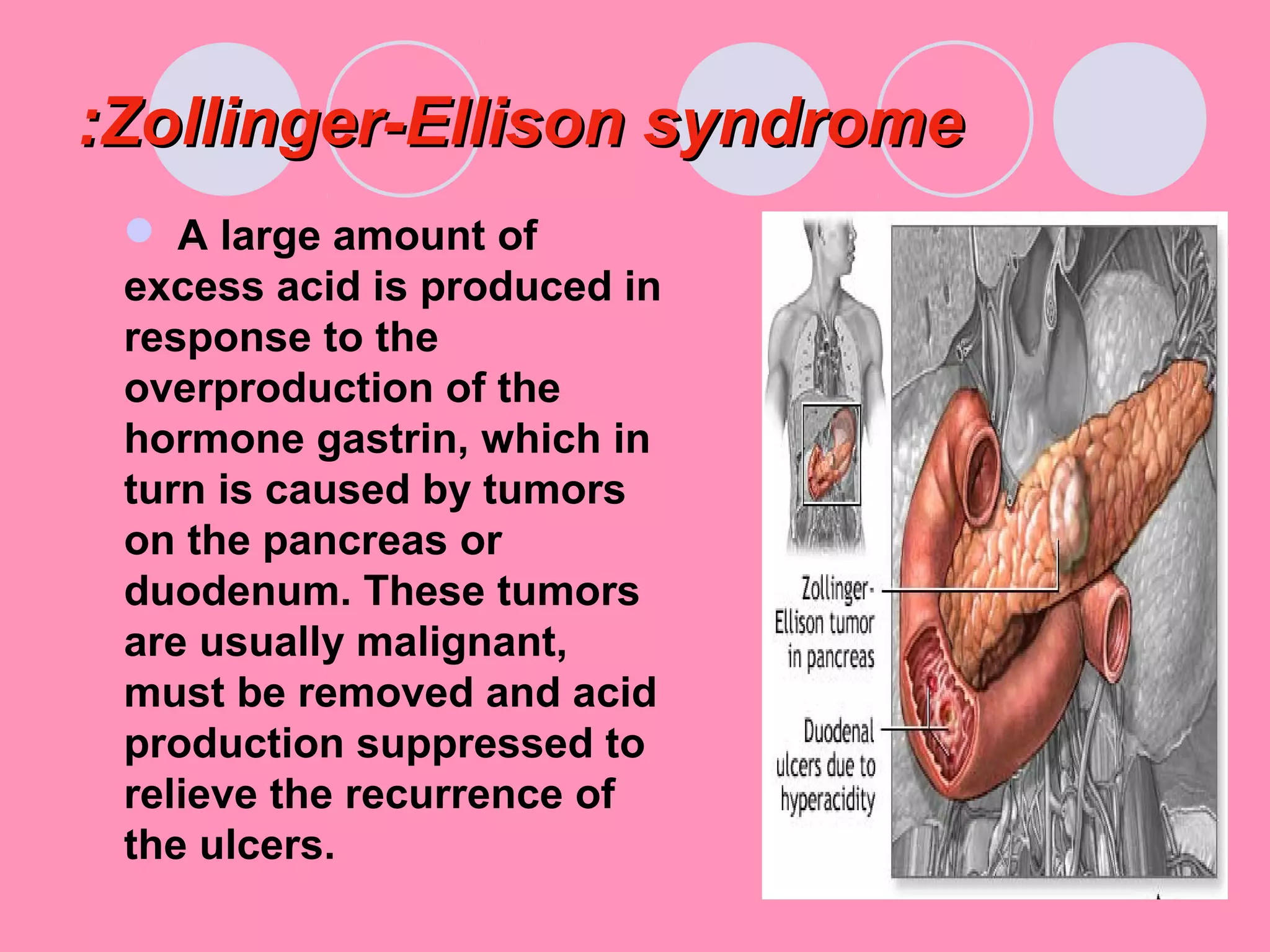 Zollinger-Ellison syndromeZollinger-Ellison syndrome::
 A large amount of
excess acid is produced in
response to the
overproduction of the
hormone gastrin, which in
turn is caused by tumors
on the pancreas or
duodenum. These tumors
are usually malignant,
must be removed and acid
production suppressed to
relieve the recurrence of
the ulcers.
 