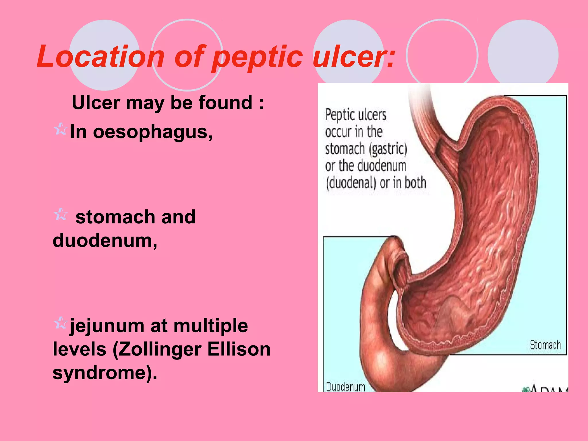 Location of peptic ulcer:
Ulcer may be found :
In oesophagus,
 stomach and
duodenum,
jejunum at multiple
levels (Zollinger Ellison
syndrome).
 