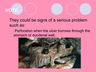NOTE:
They could be signs of a serious problem
such as:
Perforation when the ulcer burrows through the
stomach or duodenal wall.
 