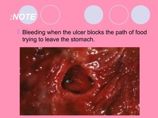 NOTE:
 Bleeding when the ulcer blocks the path of food
trying to leave the stomach.
 