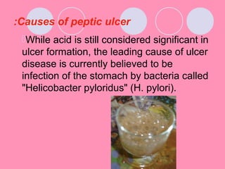 Causes of peptic ulcer:
While acid is still considered significant in
ulcer formation, the leading cause of ulcer
disease is currently believed to be
infection of the stomach by bacteria called
"Helicobacter pyloridus" (H. pylori).
 